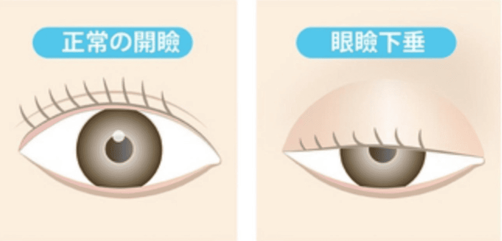 眼瞼手術