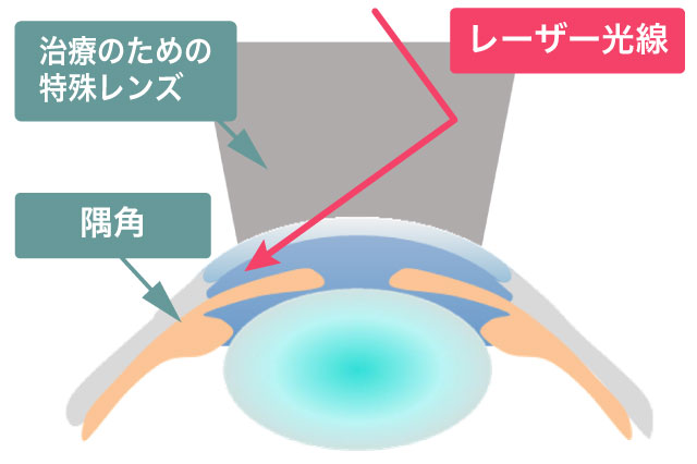 緑内障治療2